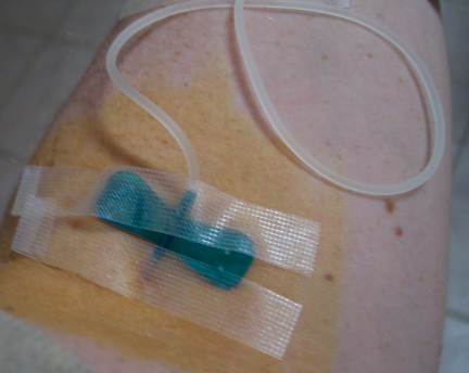 Picture of the IV needle in my arm just below me left elbow